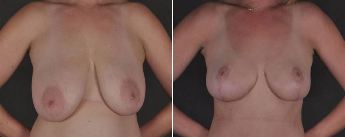 Mommy Makeover Before and After Photos in Omaha, NE, Case 17518