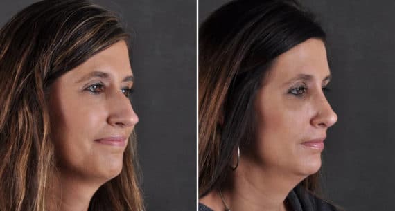 Rhinoplasty Before and After Photos in Omaha, NE, Case 8645