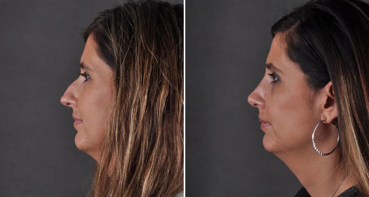 Rhinoplasty Before and After Photos in Omaha, NE, Case 8645