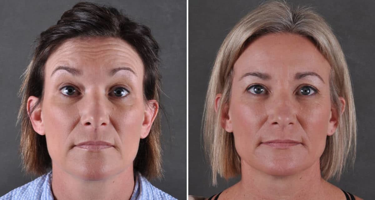 Blepharoplasty Before and After Photos in Omaha, NE, Case 8902