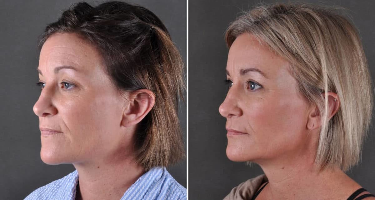 Blepharoplasty Before and After Photos in Omaha, NE, Case 8902