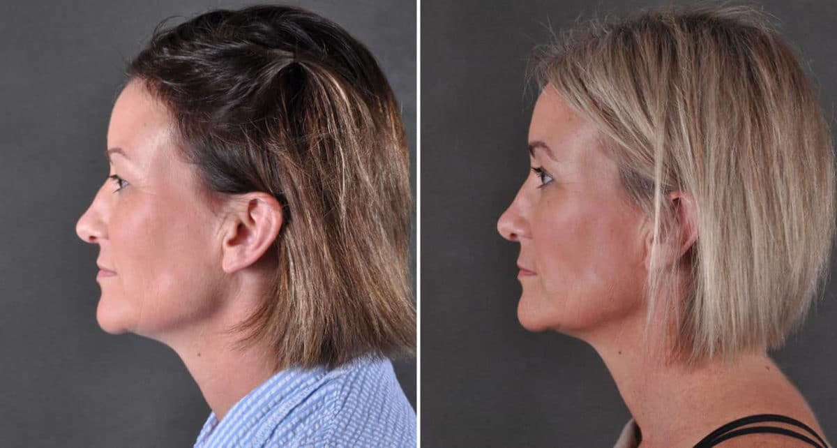 Blepharoplasty Before and After Photos in Omaha, NE, Case 8902