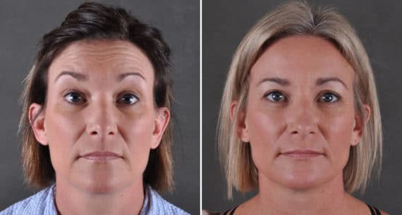 Blepharoplasty Before and After Photos in Omaha, NE, Case 8902