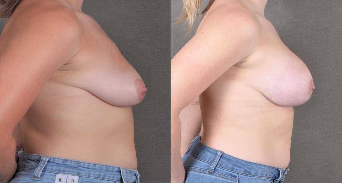 Breast Augmentation Before and After Photos in Omaha, NE, Case 18322