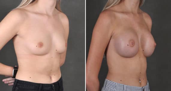 Breast Augmentation Before and After Photos in Omaha, NE, Case 18505