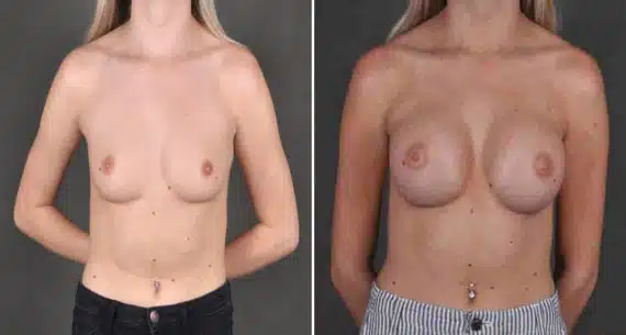 Breast Augmentation Before and After Photos in Omaha, NE, Case 18505