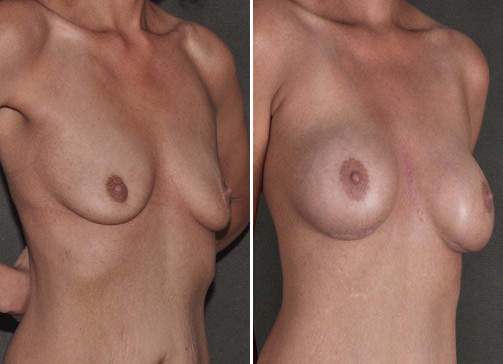 Mommy Makeover Before and After Photos in Omaha, NE, Case 18579