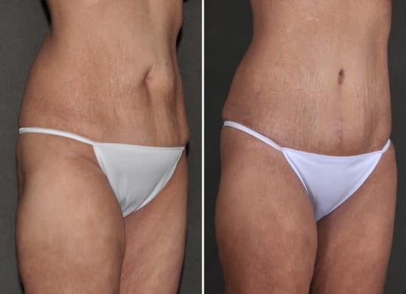 Tummy Tuck Before and After Photos in Omaha, NE, Case 18603