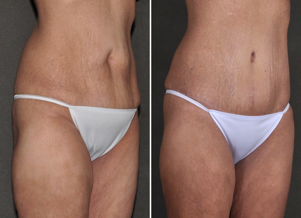 Tummy Tuck Before and After Photos in Omaha, NE, Case 18603