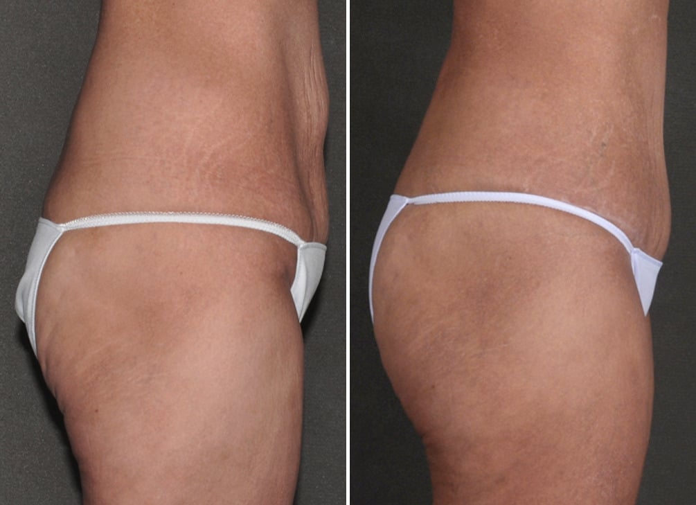 Tummy Tuck Before and After Photos in Omaha, NE, Case 18603