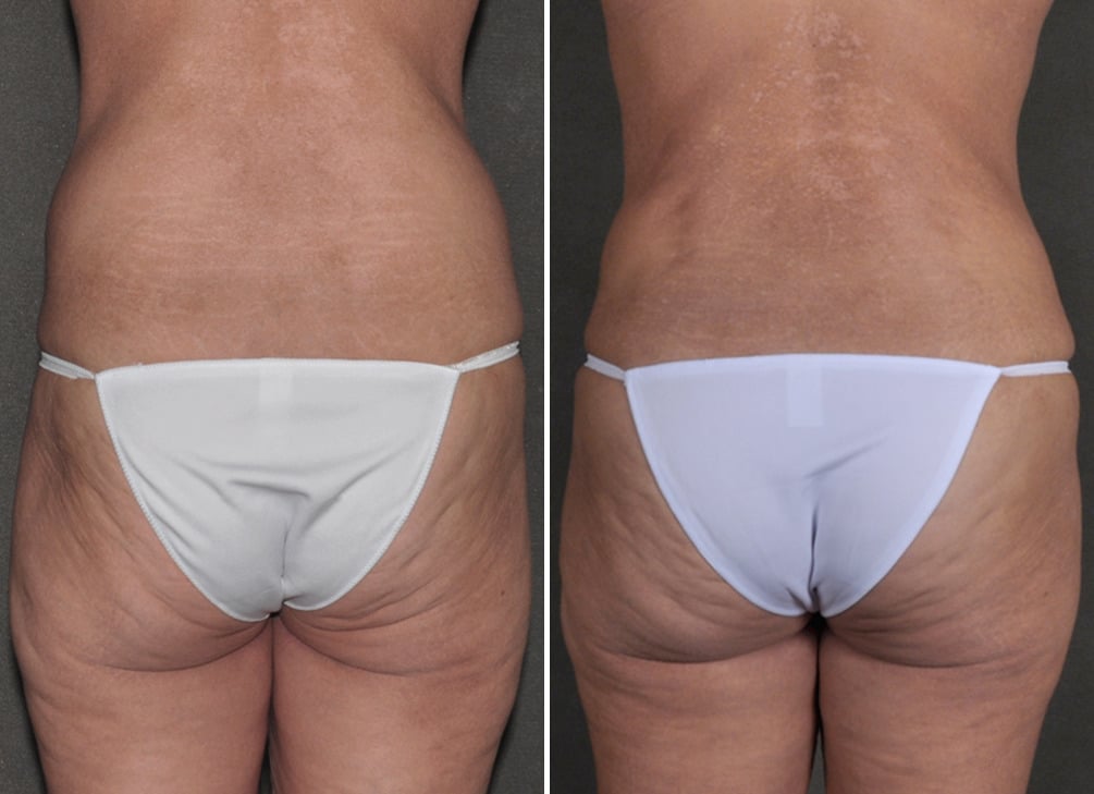 Tummy Tuck Before and After Photos in Omaha, NE, Case 18603