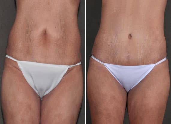 Tummy Tuck Before and After Photos in Omaha, NE, Case 18603