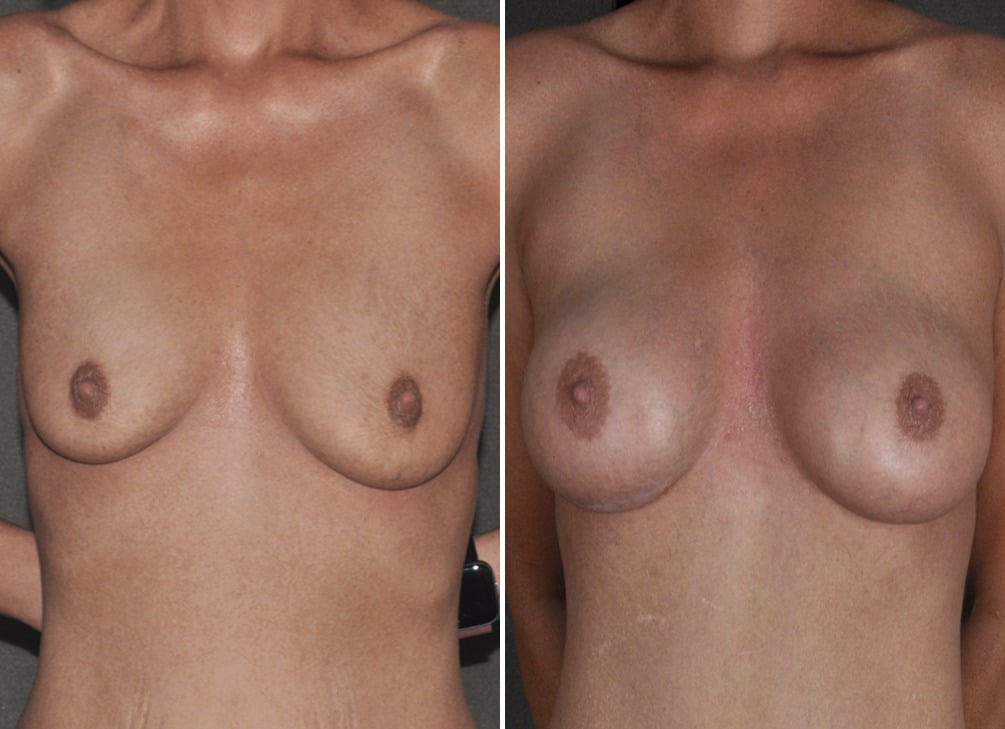 Breast Augmentation Before and After Photos in Omaha, NE, Case 18608