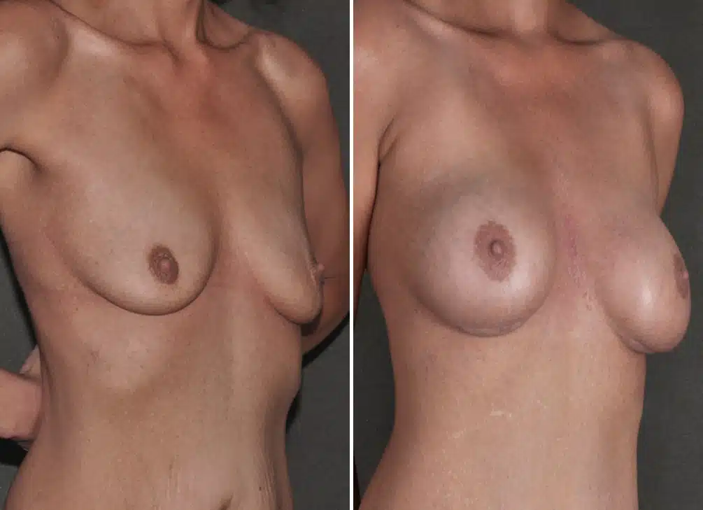 Breast Augmentation Before and After Photos in Omaha, NE, Case 18608