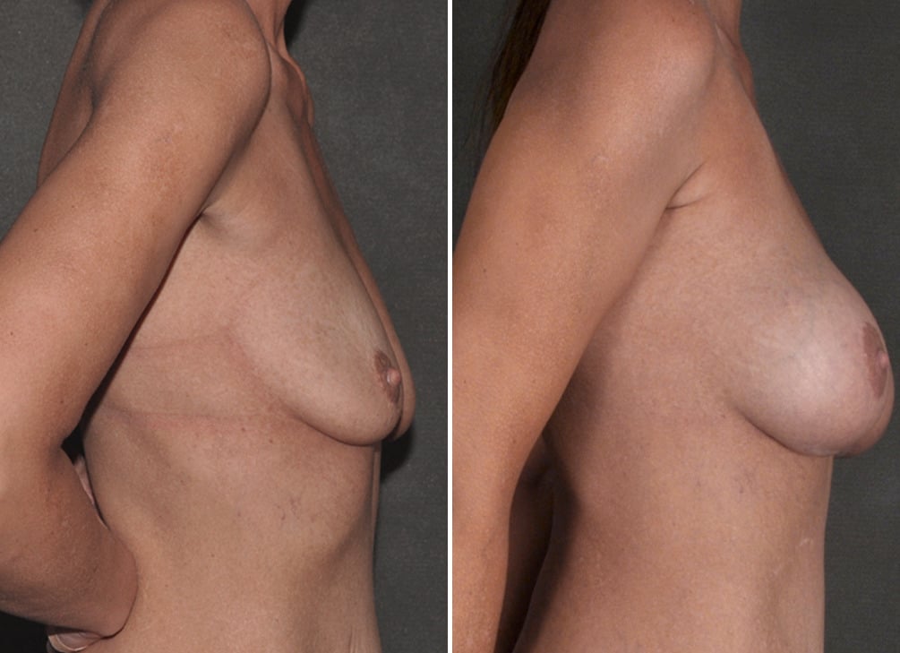 Breast Augmentation Before and After Photos in Omaha, NE, Case 18608