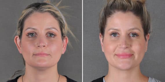 Otoplasty Before and After Photos in Omaha, NE, Case 18658