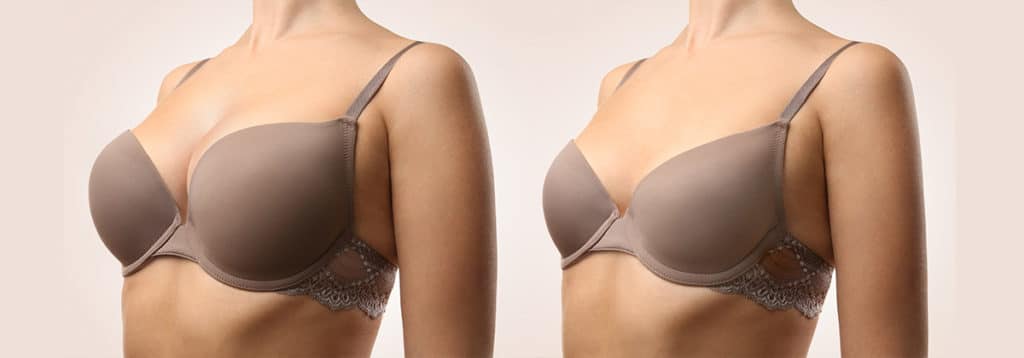 Before and after picture of a breast reduction procedure