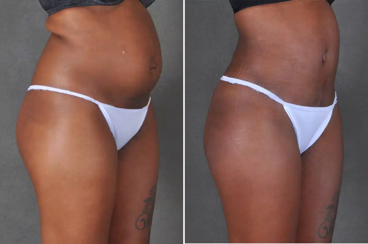 Liposuction Before and After Photos in Omaha, NE, Case 18764