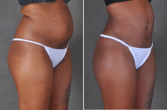 Liposuction Before and After Photos in Omaha, NE, Case 18764