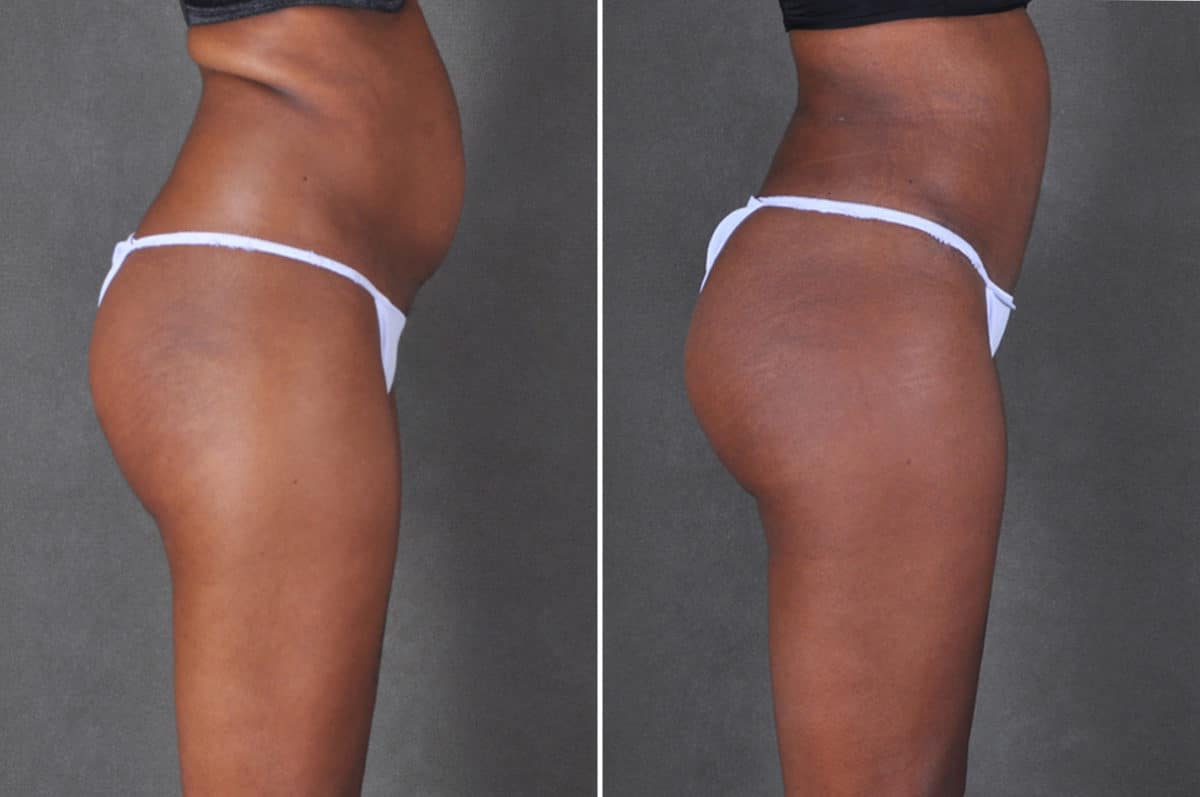 Liposuction Before and After Photos in Omaha, NE, Case 18764