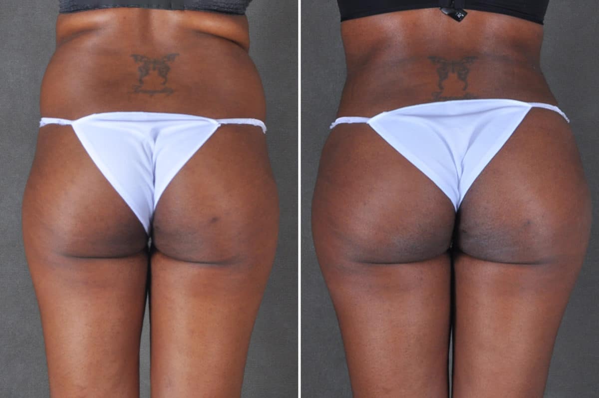 Liposuction Before and After Photos in Omaha, NE, Case 18764