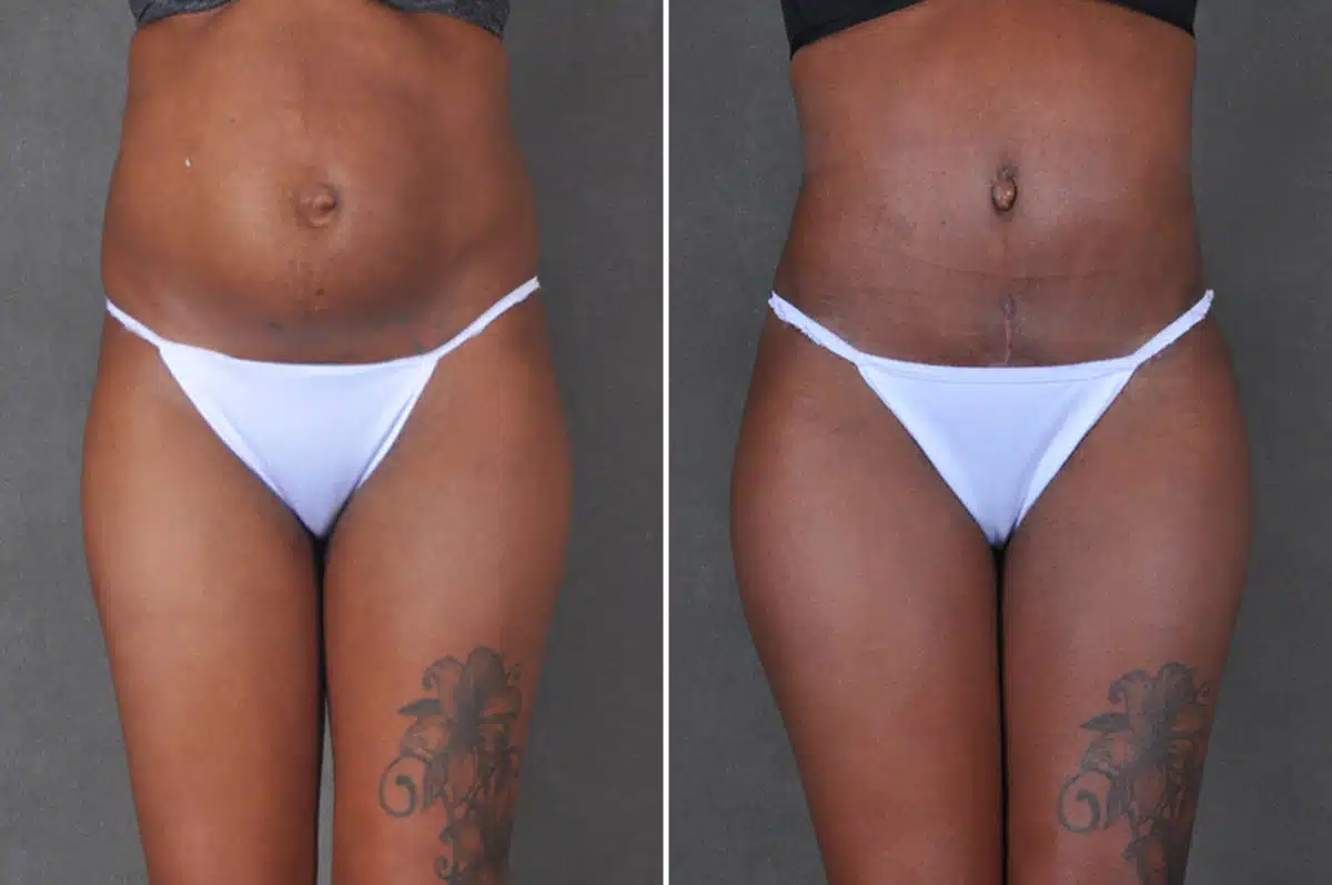 Liposuction Before and After Photos in Omaha, NE, Case 18764