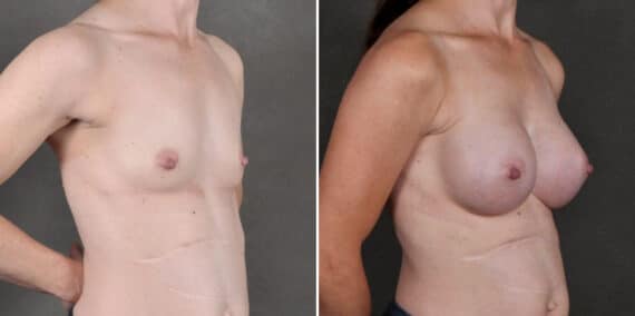 Breast Augmentation Before and After Photos in Omaha, NE, Case 18914