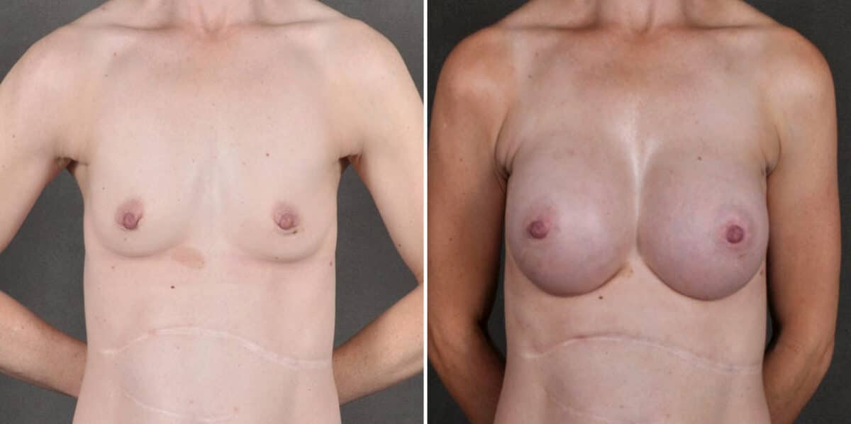 Breast Augmentation Before and After Photos in Omaha, NE, Case 18914