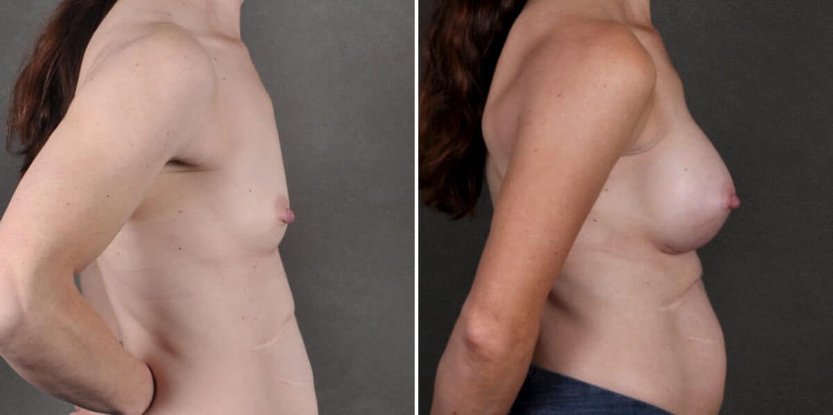 Breast Augmentation Before and After Photos in Omaha, NE, Case 18914