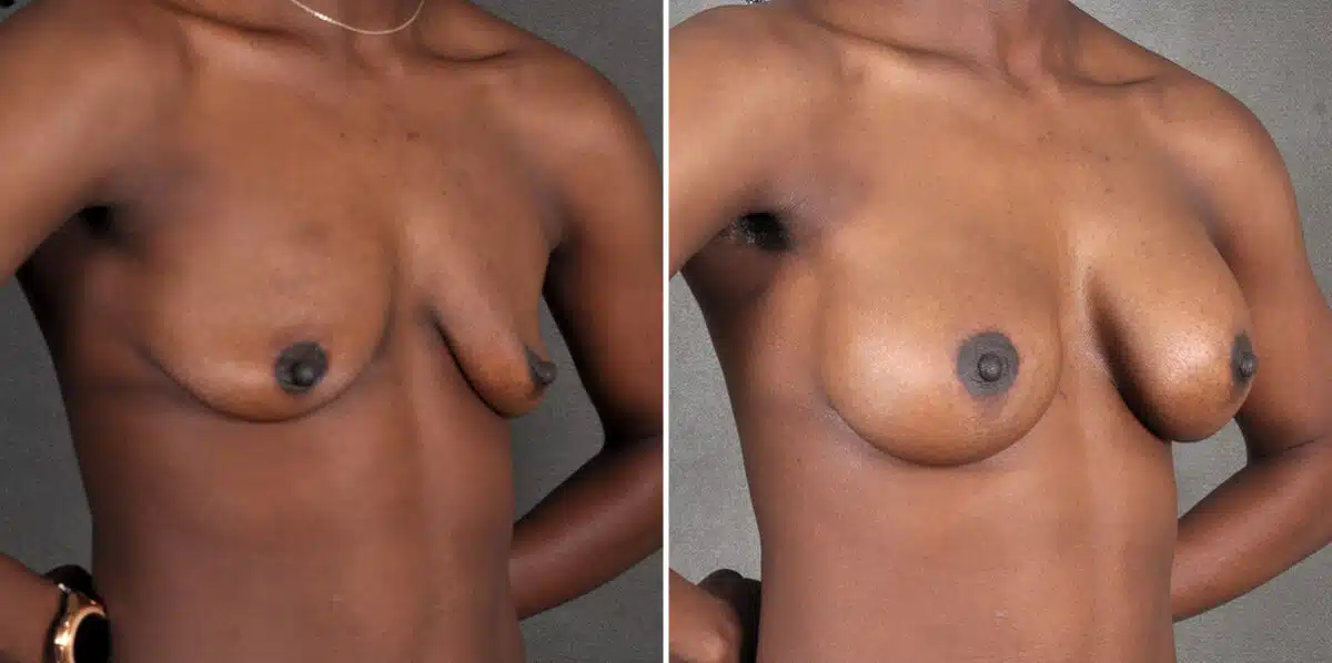 Breast Augmentation Before and After Photos in Omaha, NE, Case 18915