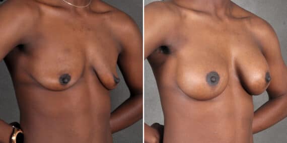 Breast Augmentation Before and After Photos in Omaha, NE, Case 18915