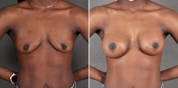 Breast Augmentation Before and After Photos in Omaha, NE, Case 18915