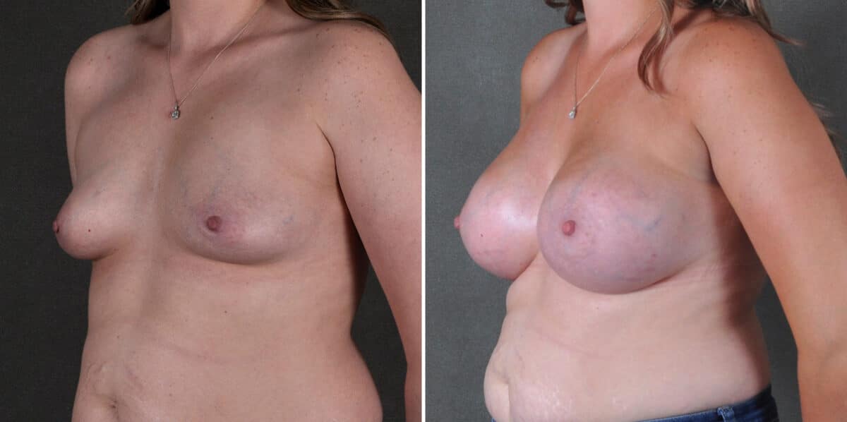 Breast Augmentation Before and After Photos in Omaha, NE, Case 18934