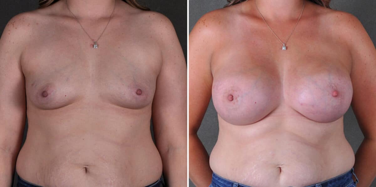 Breast Augmentation Before and After Photos in Omaha, NE, Case 18934