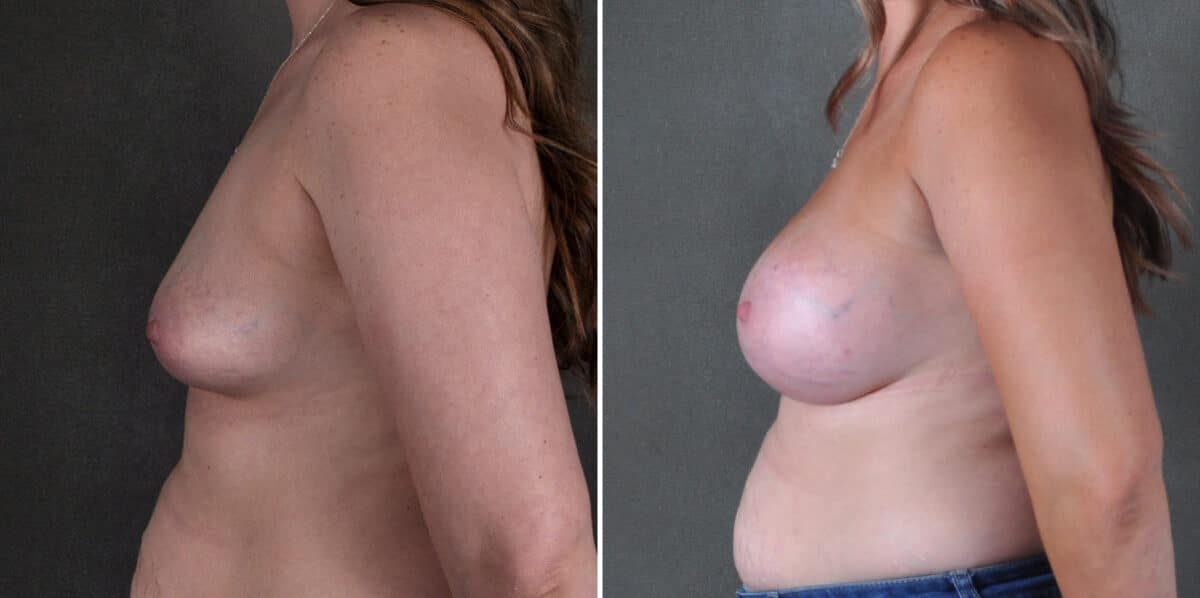 Breast Augmentation Before and After Photos in Omaha, NE, Case 18934