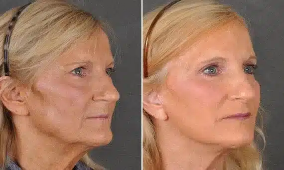 Facelift Before & After Photos