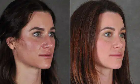 Rhinoplasty Before and After Photos in Omaha, NE, Case 19243