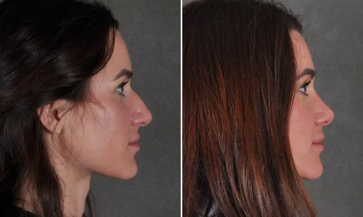 Rhinoplasty Before and After Photos in Omaha, NE, Case 19243