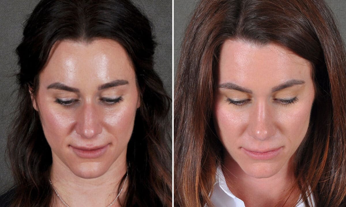 Rhinoplasty Before and After Photos in Omaha, NE, Case 19243