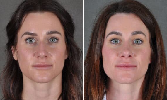 Rhinoplasty Before and After Photos in Omaha, NE, Case 19243