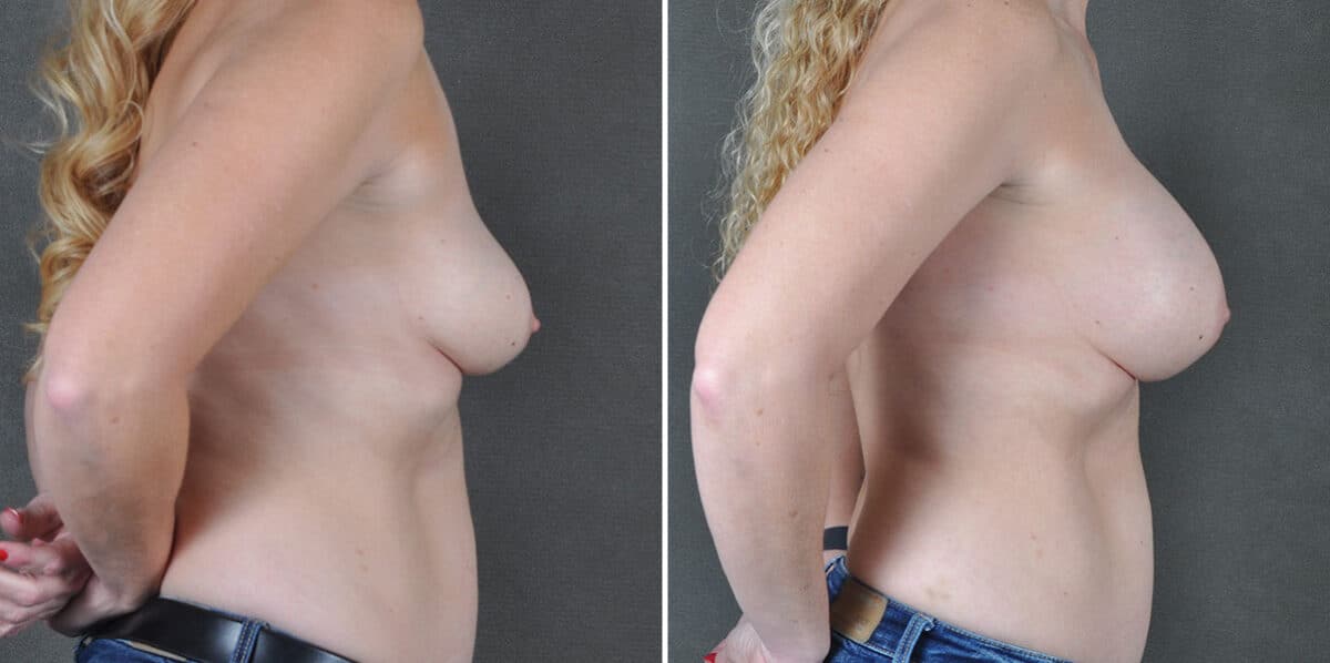 Breast Augmentation Before and After Photos in Omaha, NE, Case 19256