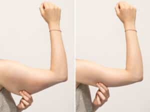 Dr. Edney provides a guide on how to deal with an arm lipo recovery time succesfully.