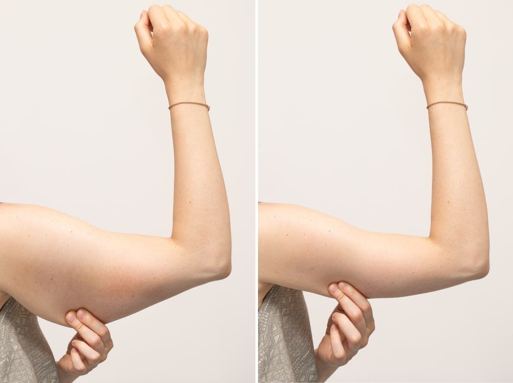 Tips and Tricks for a Successful Arm Lipo Recovery