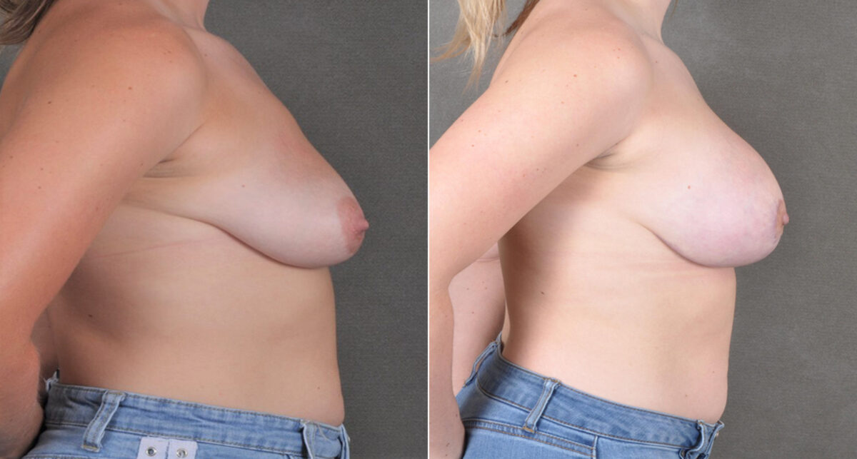 Breast Lift Before and After Photos in Omaha, NE, Case 18343