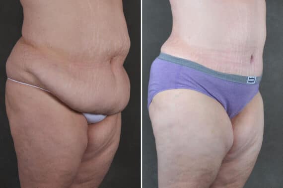 Tummy Tuck Before and After Photos in Omaha, NE, Case 19372