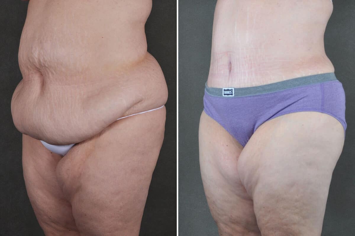 Case 19372, Tummy Tuck Before and After Photos Tummy Tuck Before and After Photos in Omaha, NE, Case 19372