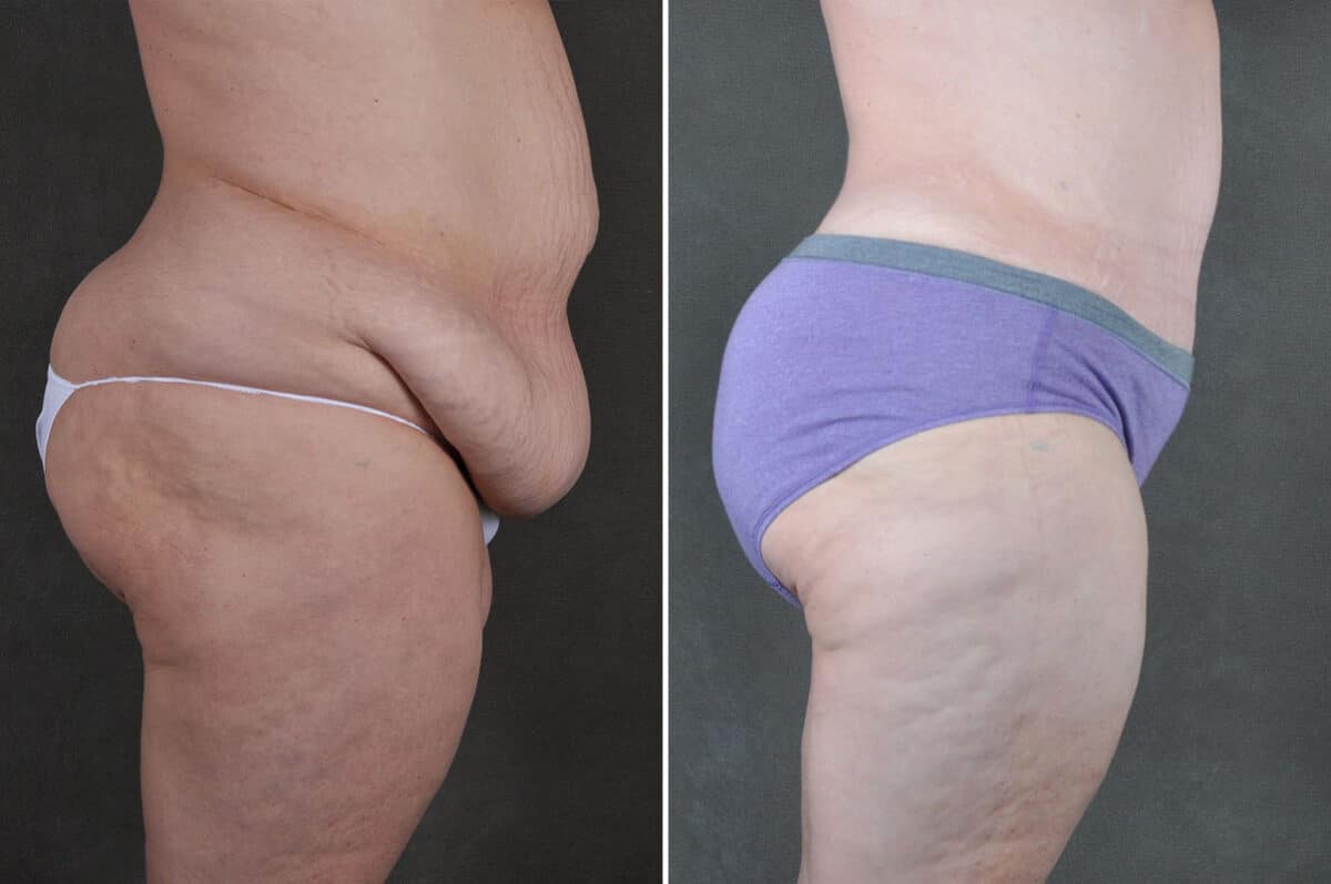 Case 19372, Tummy Tuck Before and After Photos Tummy Tuck Before and After Photos in Omaha, NE, Case 19372
