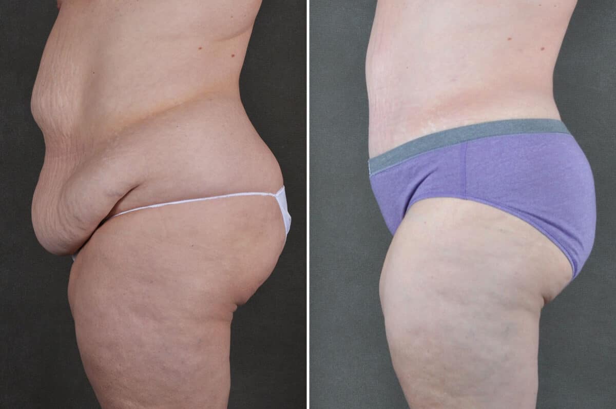 Case 19372, Tummy Tuck Before and After Photos Tummy Tuck Before and After Photos in Omaha, NE, Case 19372