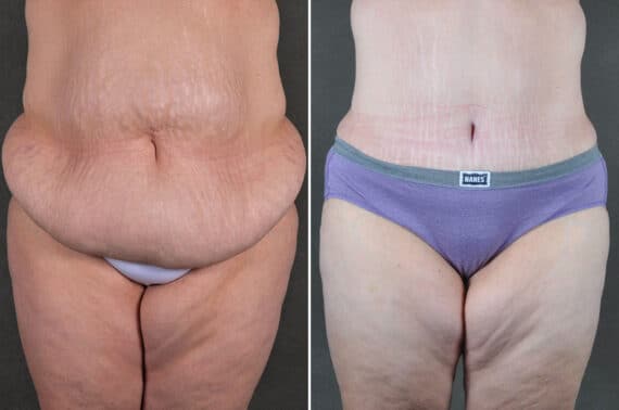 Tummy Tuck Before and After Photos in Omaha, NE, Case 19372