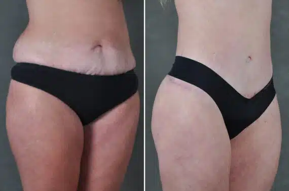 Liposuction Before and After Photos in Omaha, NE, Case 19401